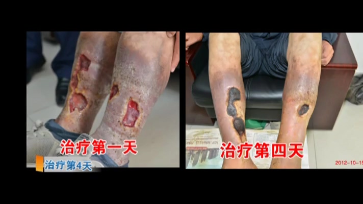 劉希山救助靜(jìng)脈炎潰爛21年(nián)小(xiǎo)夥紀實
